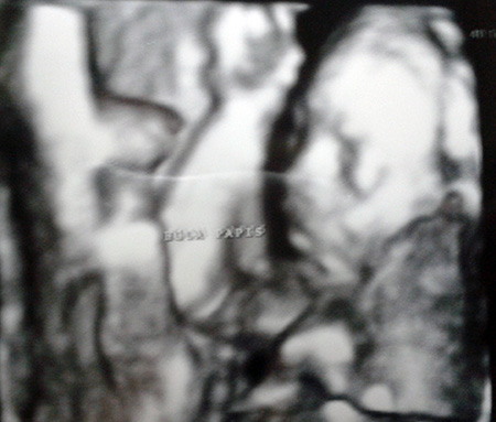 Ultrasonografía de bebe de 18 semanas. 